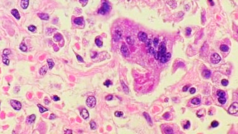 Measles virus