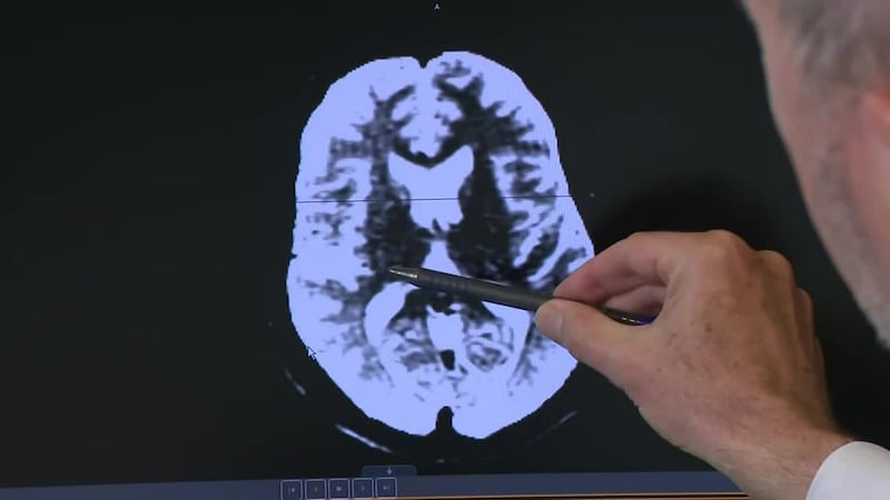 May is Stroke Awareness Month