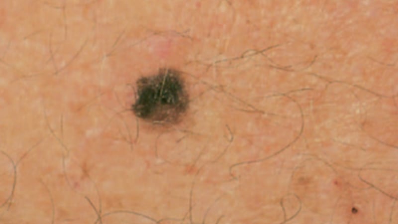 The rate of new cases is rising for six of the 10 most common cancers, and the American Cancer...